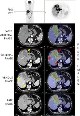 Prognostic value of integrated morphofunctional imaging methods in inoperable intrahepatic cholangiocarcinoma